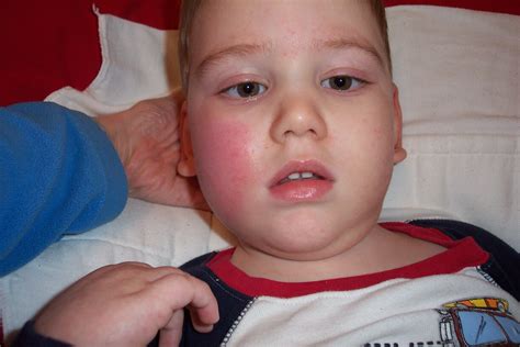 Baby Has Flushed Cheeks But No Fever at Asha Vang blog