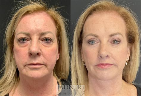 Laser Eyelid Lift