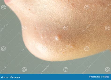 Close-up Of Molluscum Contagiosum Also Called Water Wart. Viral ...
