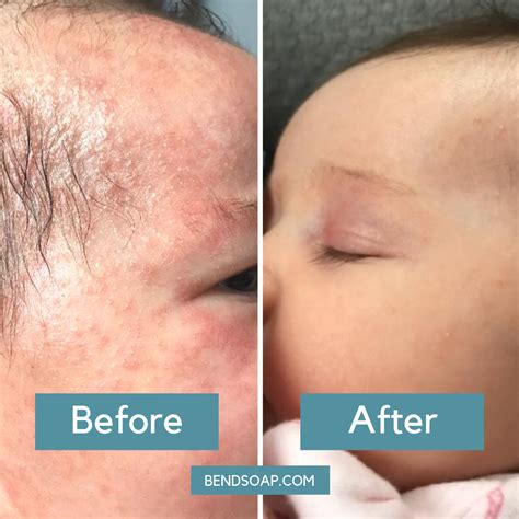 Baby Face Lotion For Acne at Lucas Cade blog