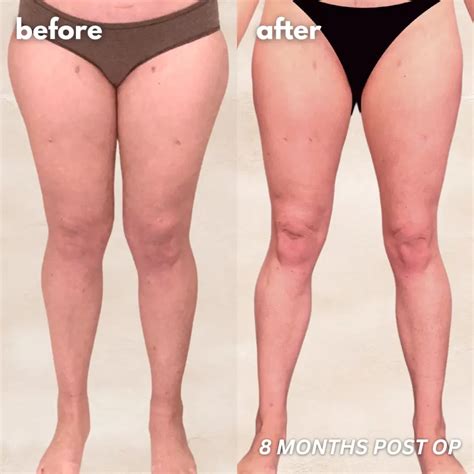 Una guía completa sobre las etapas y tipos de lipedema - blogfarmaceutico.com