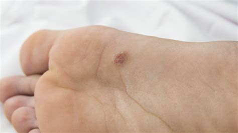 Images Of Plantar Warts