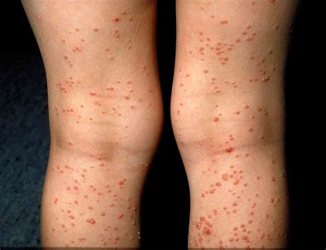 16 Causes of Viral Rashes With Pictures