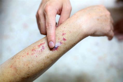 What Are Petechiae? Causes of Red Blood Spots on Your Skin