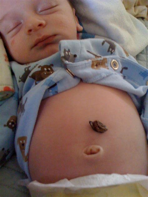 My Baby Umbilical Cord Is Bleeding at Carol Walsh blog