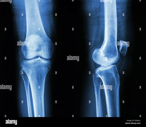 Normal knee x ray hi-res stock photography and images - Alamy