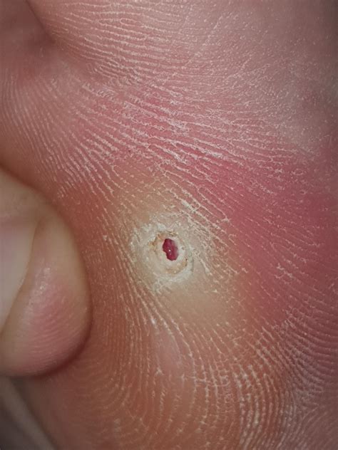 Is this hole in my foot the normal aftermath of treating a verruca ...