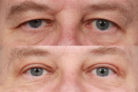 Saggy Eyelid Lift at Bonnie Call blog