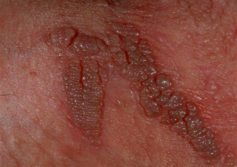 ¿Qué es el VPH y cómo se puede tratar? - Clínica Merced