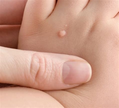Flat Warts On Hands