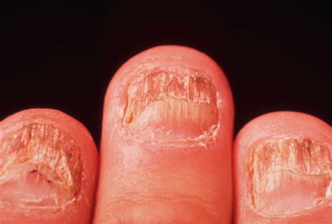 Types Of Fungal Infections On Toes at Loretta Cyr blog