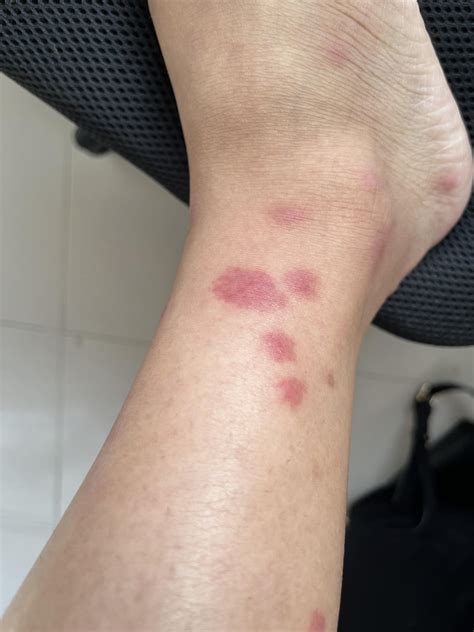 Red Mosquito Bites Pediatric Arthropod Bite Or Sting: Symptoms,