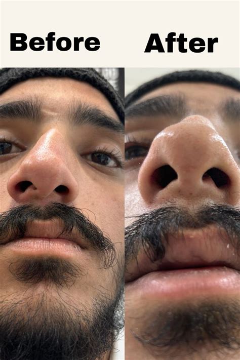 Deviated Septum Surgery Recovery Best Septoplasty Correction Of