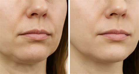 Botox for Jowls: Cost, Results & What to Expect - Eau Claire Body Care