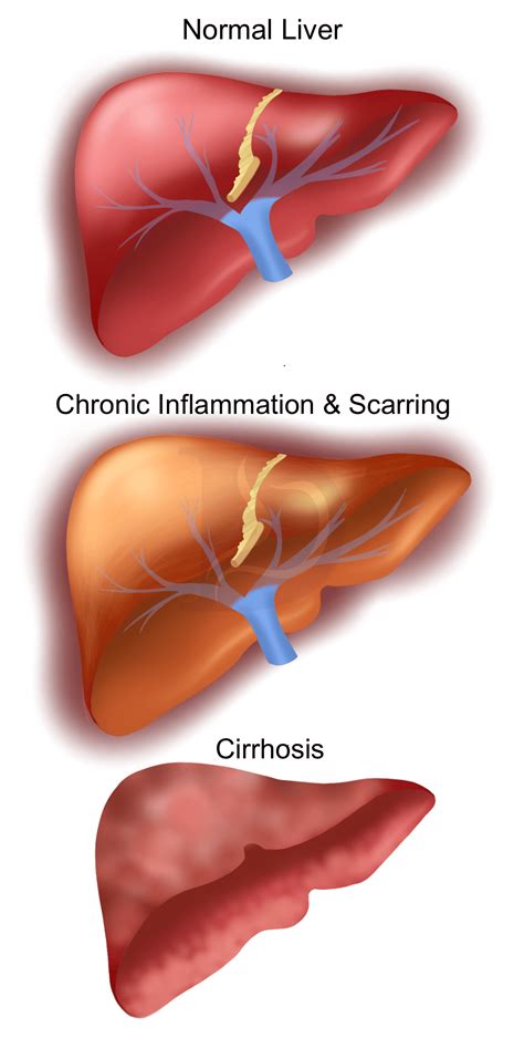Cirrhosis Of The Liver Vs Healthy Liver