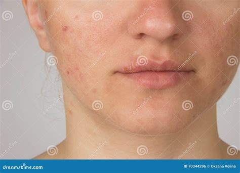 Oral Herpes Or Pimple