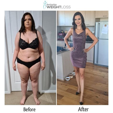 Extreme Fatigue Years After Gastric Bypass at Aurora Mcdonald blog