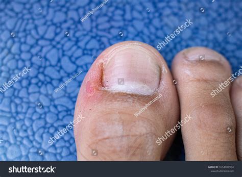 Ingrown Toenail Pus
