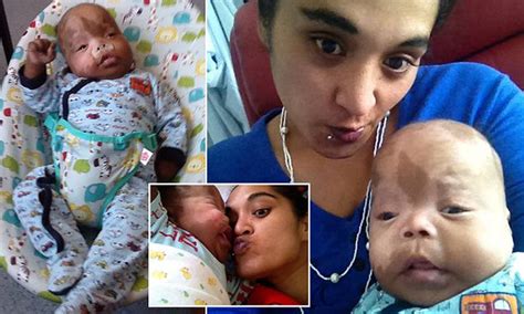 Pallister Killian Syndrome Life Expectancy - Quotes Trending