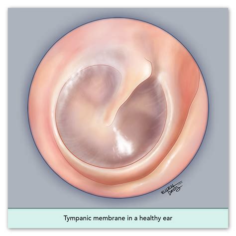 Tympanic Membrane Acute Otitis Media at Wendell Blakely blog