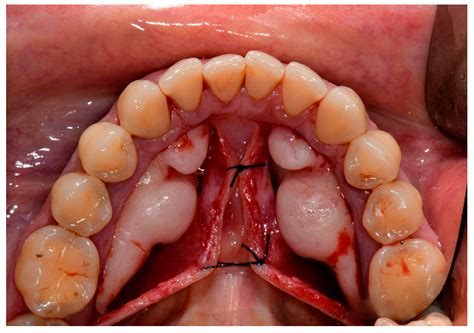Mandibular Tori Images