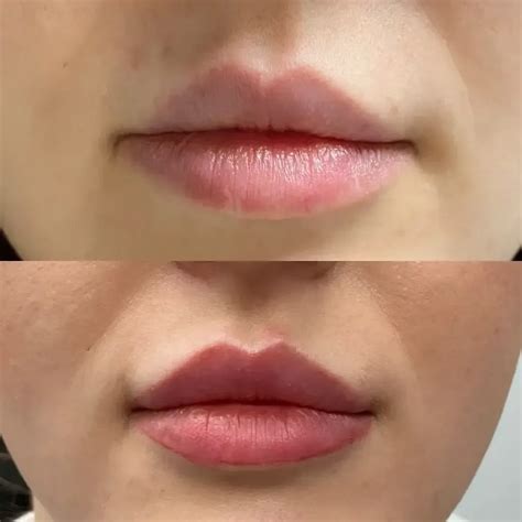 Lip Injection Options: A Comprehensive Guide | You Beauty Lounge