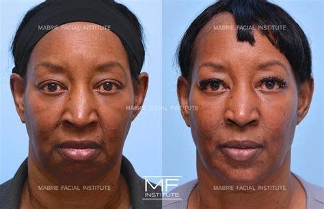 Nasolabial Fold Best Treatments For Nasolabial Folds And Marionette