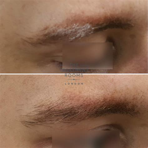 Eyebrow Hair Transplant Surgery | Treatment Rooms London