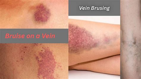When Should You Worry About a Bruise on a Vein? - Elite Vascular | New Jersey's Trusted Vascular ...