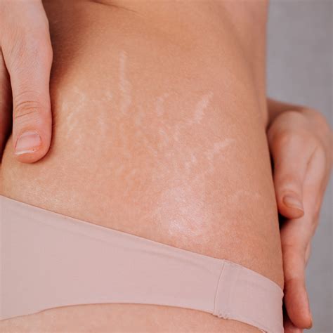 Can Stretch Marks Be Removed? Complete Guide to Treatment & Prevention – Genova Skincare