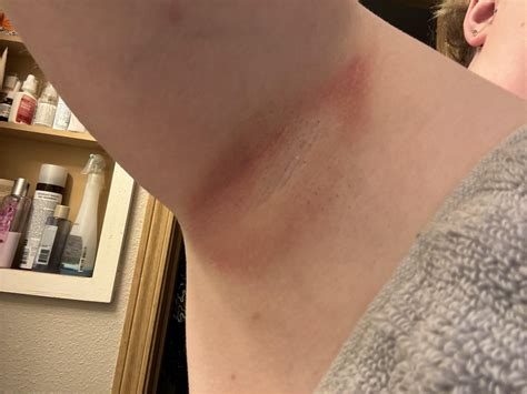 Armpit rash? : r/DermatologyQuestions