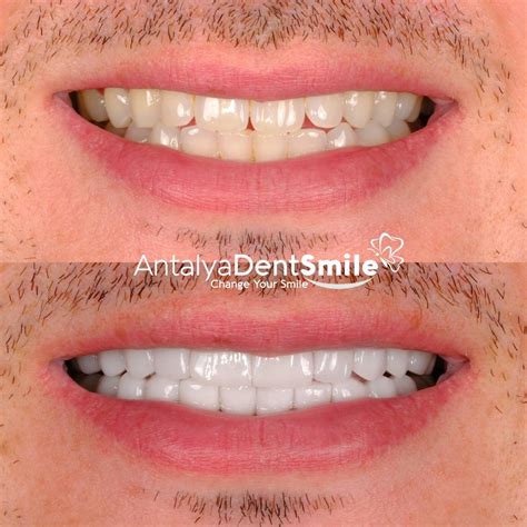 Dental Veneers Treatment: Procedure, Costs, Benefits and More - Antalya Dent Smile