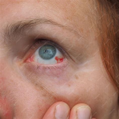 Premium Photo | Subconjunctival hemorrhage or subconjunctival bleeding ...