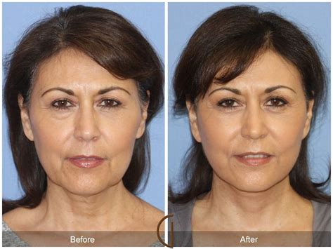 Patient 152531 | Facelift 50s Before & After Photos | Dr. Kevin Sadati