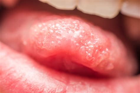 8 Causes Of Inflamed, Swollen Taste Buds, According To Doctors - SWLHHE