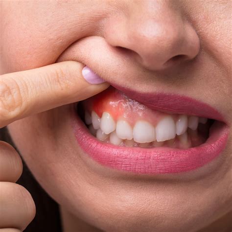 Why Do the Gums Swell and Bleed? – Dr. Reem Hejazi