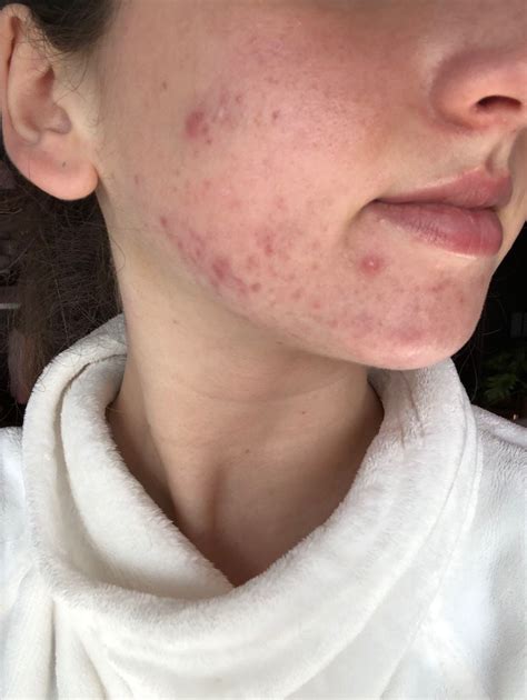 Cystic Chin Acne