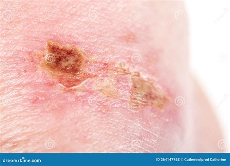 Sulfuric Acid Burns Skin