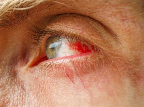 10 Spiritual Meanings of Broken Blood Vessel In The Eye - What Spiritual