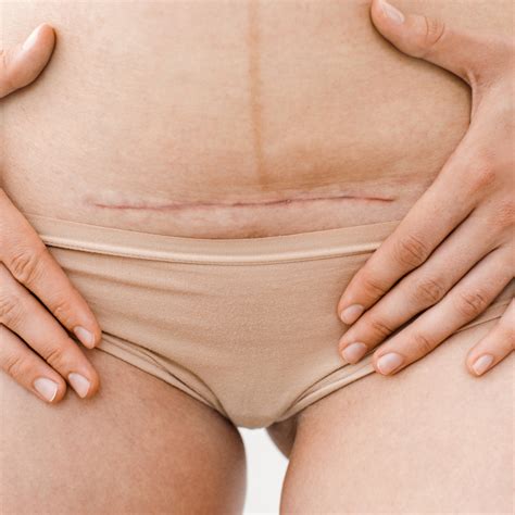 C-section Scar Massage: A Step-by-step Guide – My Expert Midwife