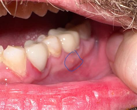 Pimple On Gums