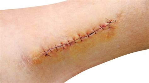 Can an Urgent Care Do Stitches? Here's What You Need to Know - Central ...