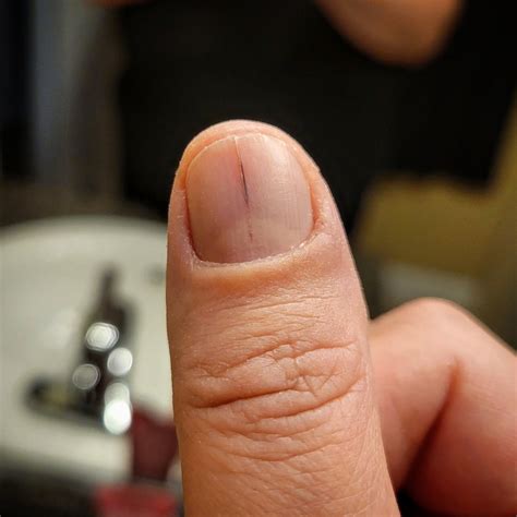 M22 dark spot on penis, please help : r/Melanoma