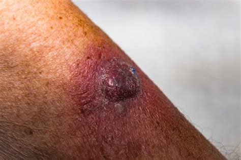 What Does Squamous Cell Carcinoma Look Like?