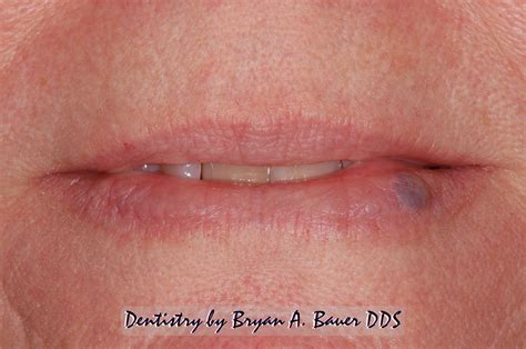 White Lumps On Lips Nhs | Lipstutorial.org