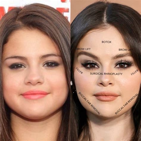 Selena gomez before and after plastic surgery – Artofit
