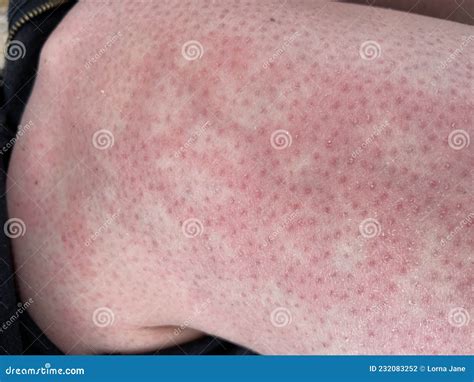 Heat Rash Hives Allergy Reaction Knee Close-up Reference Picture of Blotchy Mottled Red Skin ...