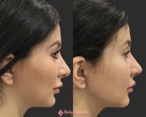 Jawline Fillers - Before & After Results at Skinly