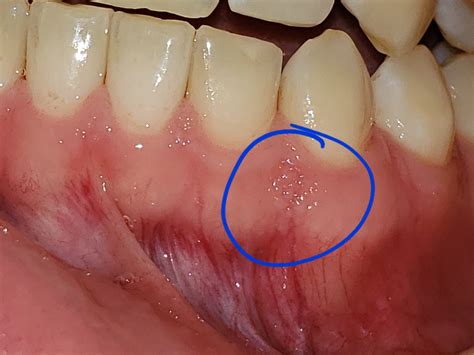 Whitish Bump On Gums