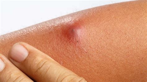 Does Anemia Cause Boils? – NutritionFact.in